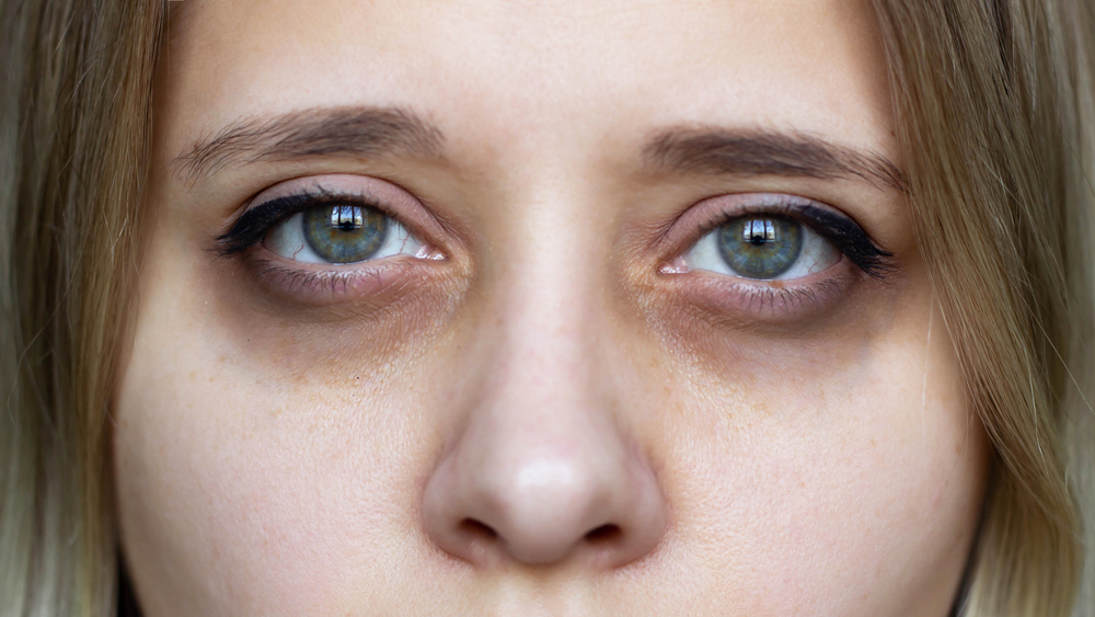 Can You Eliminate Dark Eye Circles Permanently? Truth Inside 1 eliminate dark eye circles